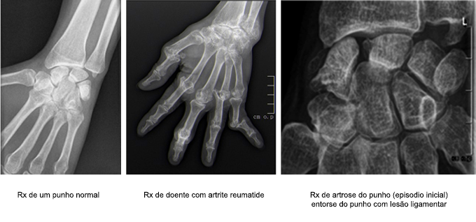 https://centrodeortopedia.org/wp-content/uploads/2022/06/Unid-PunhoMão-01Artroplastia.png