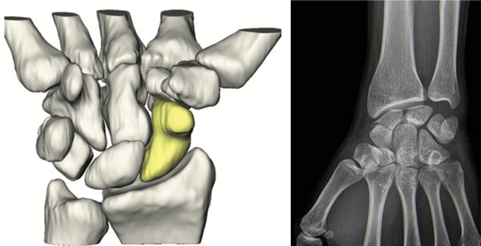 https://centrodeortopedia.org/wp-content/uploads/2022/06/Unid-PunhoMão-07fractura-escafoide.png