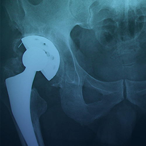 https://centrodeortopedia.org/wp-content/uploads/2022/08/Eventos-Hip-Revision-Arthroplasty.jpg