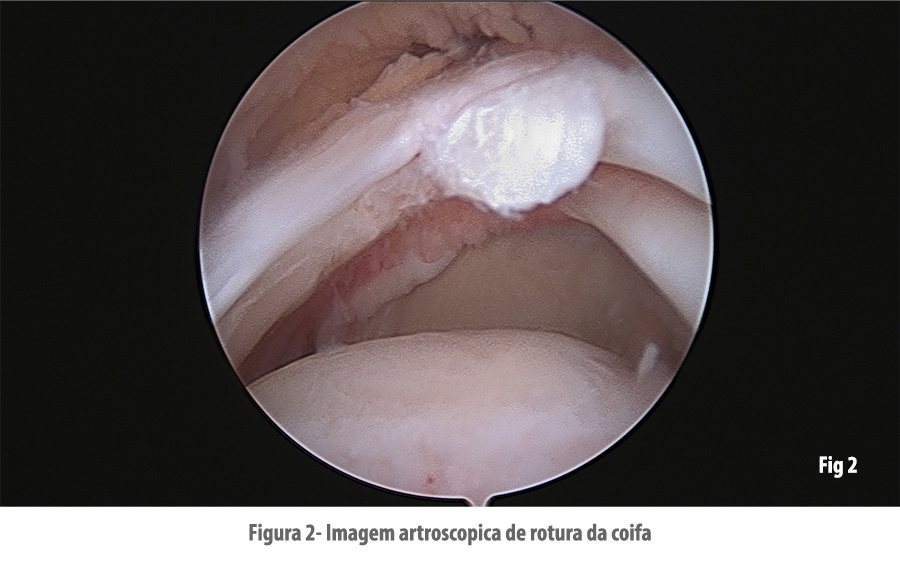 https://centrodeortopedia.org/wp-content/uploads/2022/08/Patologia-coifa-2.jpg