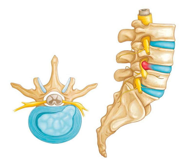 UnidColuna_Patologia_Hernia_Lombar