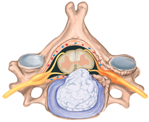 UnidColuna_Patologia_Hernia Discal