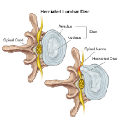 UnidColuna_Patologia_Hernia Lombar