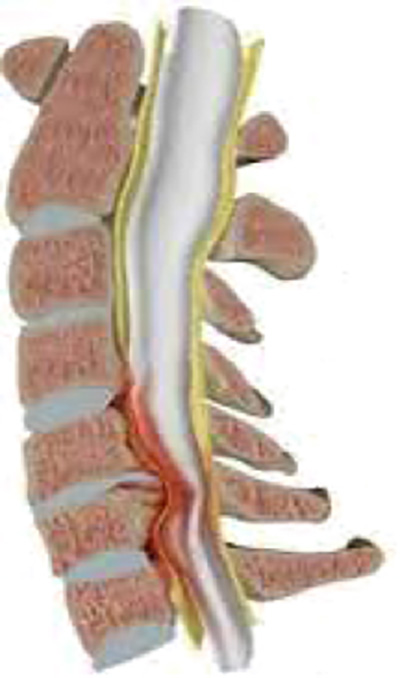 UnidColuna_Patologia_Mielopatia Cervical